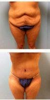 Dr Paul S. Gill, MD, Houston Plastic Surgeon - 38 Year Old Woman Treated With Tummy Tuck And Lipo To Flanks And Back