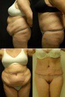 Dr Robert M. Lowen, MD, Mountain View Plastic Surgeon - 50 Y O Female, 5'7_, 170 Lbs 10 Weeks After Staged Back And Flank Liposuction Then Abdominoplasty