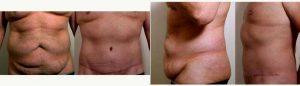 Dr Vincent N. Zubowicz, MD, Atlanta Plastic Surgeon - 49 Year Old Man Treated With Tummy Tuck