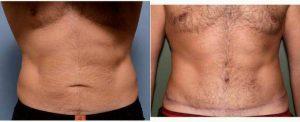 Dr. Barry L. Eppley, MD, DMD, Indianapolis Plastic Surgeon - 48 Year Old Man Treated With Tummy Tuck