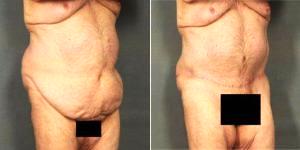 Dr. Ellen A. Janetzke, MD, Bloomfield Hills Plastic Surgeon - 59 Year Old Man Treated With Tummy Tuck