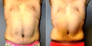 Dr. Scott Barr, MD, Sudbury Plastic Surgeon - Abdominoplasty - 31 Year Old Male, 2 Months Post-op