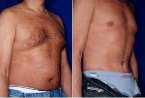 Dr. Stephen J. Ronan, MD, FACS, San Francisco Plastic Surgeon - Male Tummy Tuck Before And After (1)