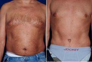 Dr. Stephen J. Ronan, MD, FACS, San Francisco Plastic Surgeon - Male Tummy Tuck Before And After (2)