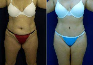 Tummy Tuck And Lipo To Flanks With Dr Ricardo L. Rodriguez, MD, Baltimore Plastic Surgeon