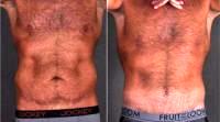 46 Year Old Man Treated With Tummy Tuck Before By Dr. Richard J. Bruneteau, MD, Omaha Plastic Surgeon