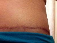 Affordable Tummy Tuck With Doctor Lisa Bootstaylor, MD, Atlanta Plastic Surgeon