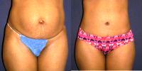 Doctor Adam L. Basner, MD, Baltimore Plastic Surgeon - 31 Year Old Woman Treated With Tummy Tuck