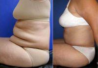 Doctor Austin Hayes, MD, Portland Plastic Surgeon - 55 Year Old Woman Treated With Tummy Tuck