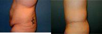 Doctor Gregory Baum, MD, Syracuse Plastic Surgeon - 25 Year Old Woman Treated With Tummy Tuck