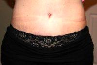 Doctor Jayesh Panchal, MD, Edmond Plastic Surgeon What's Involved In A Tummy Tuck