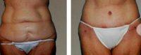 Doctor Jeremy S. Hurren, BSc, MBBS, FRCS (Plast), Chichester Plastic Surgeon Affordable Tummy Tuck