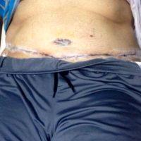 Doctor Johnny Franco, MD, FACS, Austin Plastic Surgeon Modified Tummy Tuck