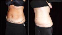 Doctor Leon Goldstein, MD, Madison Plastic Surgeon - 45 Year Old Woman Treated With Tummy Tuck