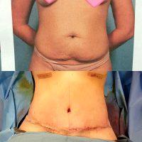 Doctor Mathieu L. Hinze, MD, Lincoln Plastic Surgeon Liposuction And Tummy Tuck Surgery Picture
