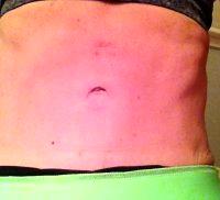 Dr Andrew P. Trussler, MD, Austin Plastic Surgeon Tummy Tuck With Lipo Pic