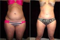 Dr Leon Goldstein, MD, Madison Plastic Surgeon - 37 Year Old Woman Treated With Tummy Tuck