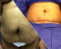 Dr. Maakan Taghizadeh, MD, Ellicott City Plastic Surgeon Affordable Tummy Tuck Near Me