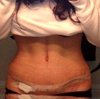 Dr. Marie E. Montag, MD, Omaha Plastic Surgeon Hysterectomy Tummy Tuck