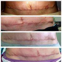 Tummy Tuck Treatment By Dr. Andrew Turk, MD, Naples Plastic Surgeon