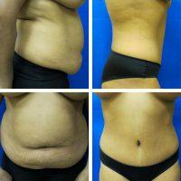 Tummy Tuck Weight Loss With Dr Kara K. Criswell, MD, FACS, Charlotte Plastic Surgeon