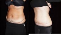 45-54 year old woman treated with Tummy Tuck