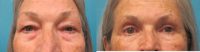 55-64 year old woman treated with Upper and Lower Eyelid Blepharoplasty by Dr Michele Koo