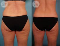 35-44 year old woman treated with Liposculpture