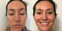 25-34 year old woman treated with Facial
