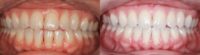 25-34 year old woman treated with Lingual Braces
