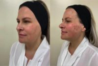 35-44 year old woman treated with Silhouette Soft