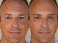 45-54 year old man treated with Dermal Fillers