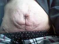 Umbilical hernia and tummy tuck image