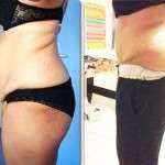 Before and after tummy tuck surgery photo