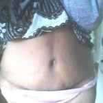147 day after tummy tuck