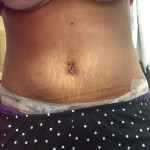 After tummy tuck 2