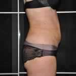 After tummy tuck photo 2