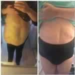 Before and after tummy tuck 10