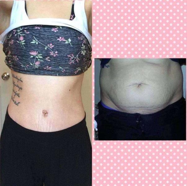 fleur de lis tummy tuck before and after