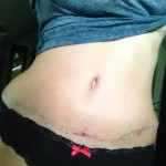 Bellybutton is finally normal looking. Tummy tuck scar