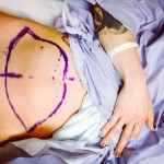 During tummy tuck