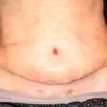 Scar of abdominoplasty