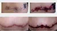 Stages of tummy tuck tattoo