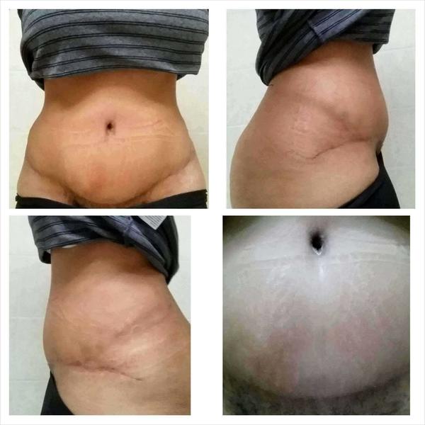 tummy tuck surgery