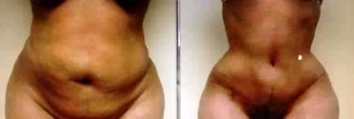 Three months post of from an Hour Glass Tuck. Third example No lipo was performed on any of these examples