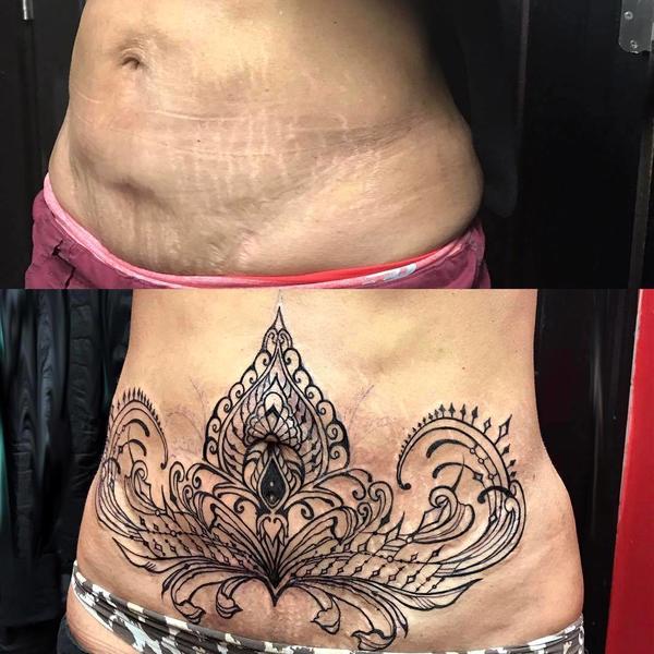tummy tuck belly button with scar