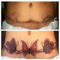Tummy Tuck Tattoo Cover Ups Pictures (23)