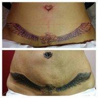 Tummy Tuck Tattoo To Cover Scar Pictures (1)