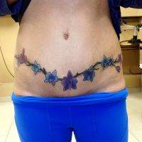 Tummy Tuck Tattoo To Cover Scar Pictures (4)