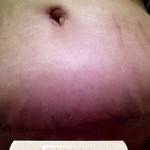 Tummy tuck before and after pictures gallery of patients